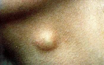 hard white spots on scrotum